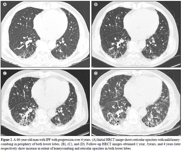 66세 특발성 폐섬유증 환자의 흉부방사선사진. 왼쪽 위(1년)부터 오른쪽 아래(4년)까지 병의 진행 상황을 볼 수 있다. 양측 폐에서 섬유화된 면적이 넓어지면서 병이 깊어진다. /고려대 안암병원 영상의학과 제공