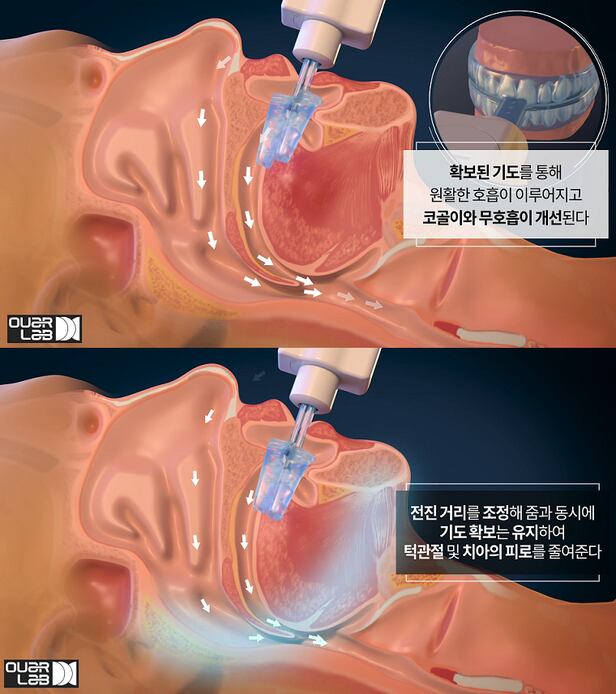 아워랩의 폐쇄성 수면무호흡증 치료기기 '옥슬립'의 작동 원리. /유튜브 캡처