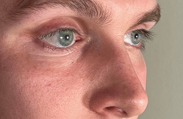 환자의 오른쪽 눈(사진의 왼쪽)은 인공으로 만든 의안이지만 실제 눈과 흡사해 구별하기 어렵다. 독일 연구진은 AI와 3D 프린터를 이용해 모양과 외관이 실제와 거의 흡사한 의안을 만들었다./Occupeye