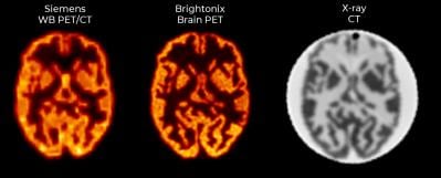 A comparison of brain scans from Pharos, a positron emission tomography (PET) system developed by Brightonics Imaging, and a PET system from Siemens in Germany; the center is Pharos, and the left shows the Siemens system's result./Courtesy of Brightonics Imaging