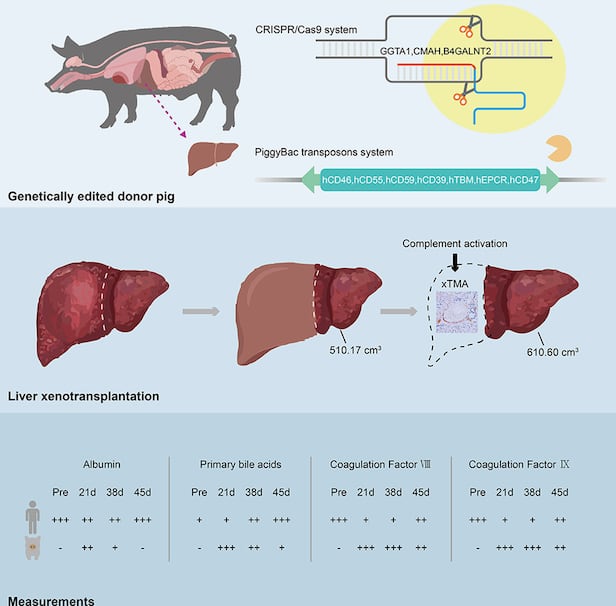 돼지 간을 환자에 이식한 과정. 면역거부반응이 없도록 돼지의 유전자를 편집한 다음(위), 간을 적출해 일부를 환자 간에 붙였다(가운데). 이식한 돼지 간은 부피가 늘었으며, 하루 최대 400mL 담즙을 분비하며 대사 기능을 수행했다(아래)./Journal of Hepatology