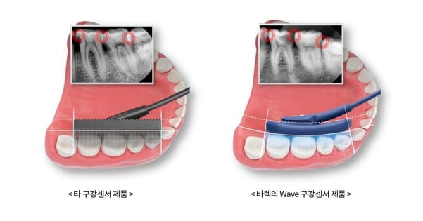 바텍, 구강 모양 맞춤형 치과용 구강센서 출시 - 조선비즈